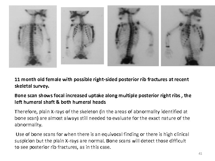 11 month old female with possible right-sided posterior rib fractures at recent skeletal survey.