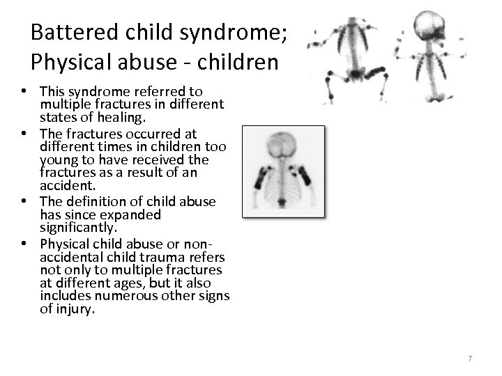 Battered child syndrome; Physical abuse - children • This syndrome referred to multiple fractures