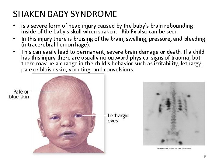 SHAKEN BABY SYNDROME • is a severe form of head injury caused by the