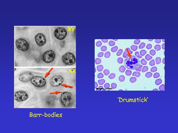 XY XX ‘Drumstick’ Barr-bodies 