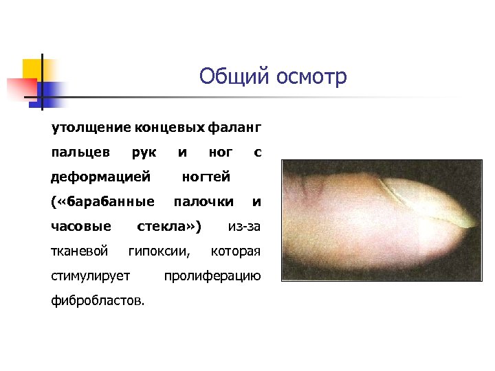 Общий осмотр утолщение концевых фаланг пальцев рук ног с деформацией ногтей ( «барабанные палочки