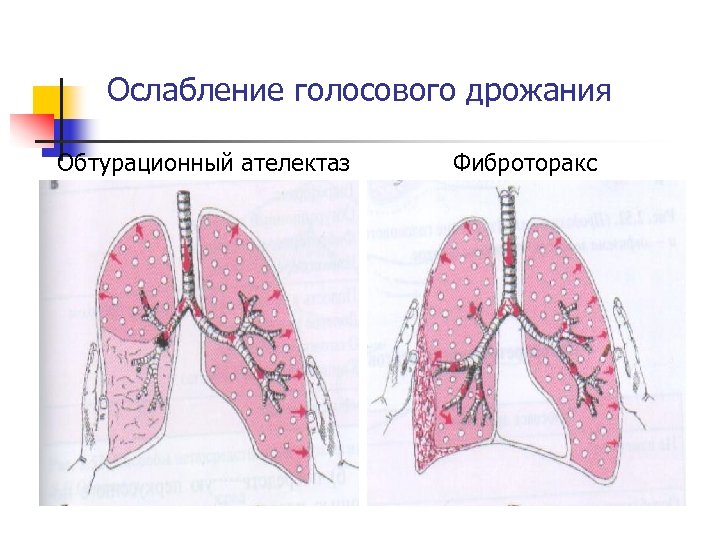 Ослабление голосового дрожания Обтурационный ателектаз Фиброторакс 