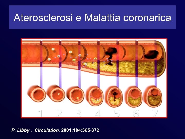 Aterosclerosi e Malattia coronarica P. Libby. Circulation. 2001; 104: 365 -372 