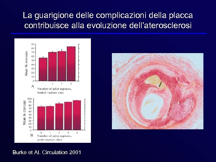 La guarigione delle complicazioni della placca contribuisce alla evoluzione dell’aterosclerosi Burke et Al. Circulation