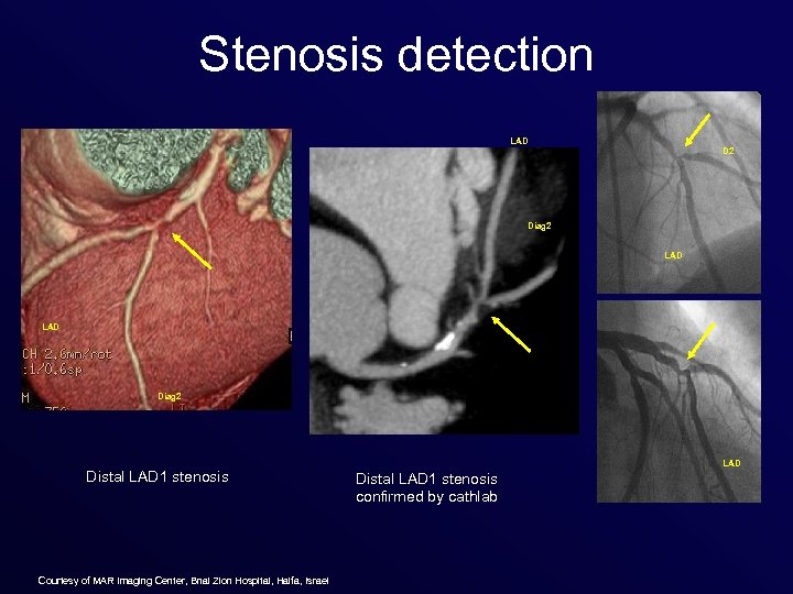 Stenosis detection LAD D 2 Diag 2 LAD Diag 2 Distal LAD 1 stenosis