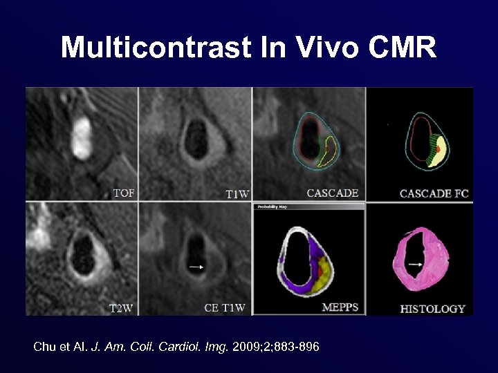 Multicontrast In Vivo CMR Chu et Al. J. Am. Coll. Cardiol. Img. 2009; 2;