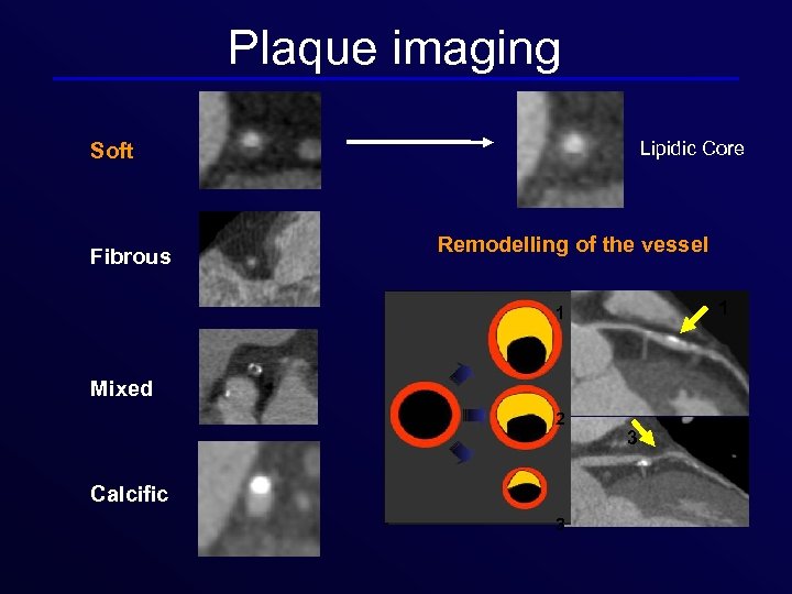 Plaque imaging Lipidic Core Soft Fibrous Remodelling of the vessel 1 1 Mixed 2