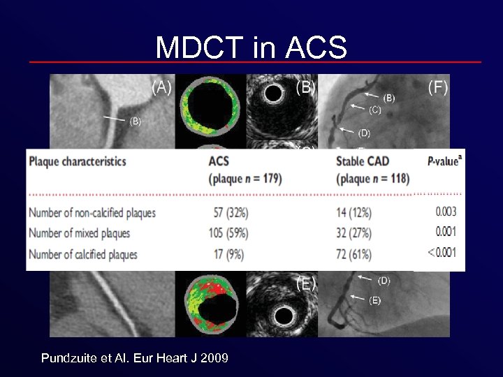 MDCT in ACS Pundzuite et Al. Eur Heart J 2009 