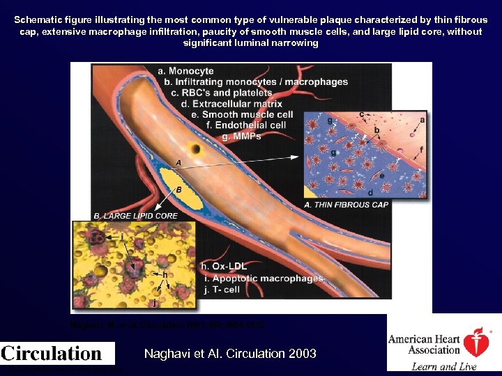 Schematic figure illustrating the most common type of vulnerable plaque characterized by thin fibrous