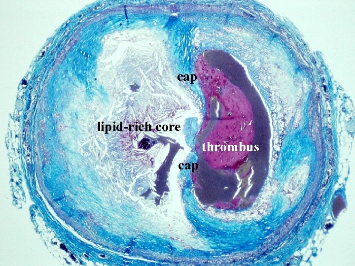 cap lipid-rich core thrombus cap 