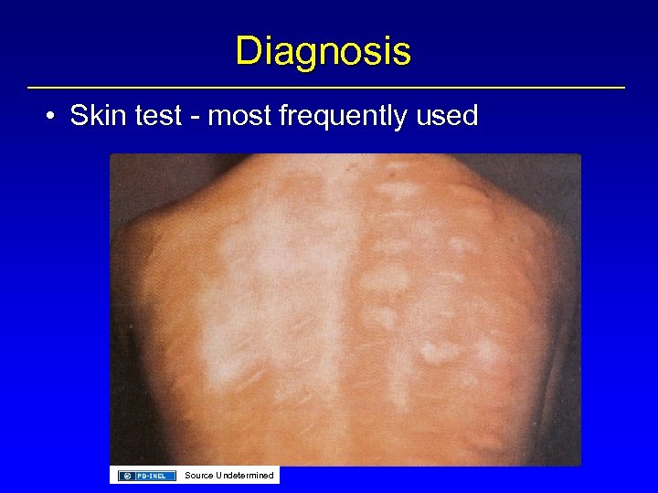 Diagnosis • Skin test - most frequently used Source Undetermined 