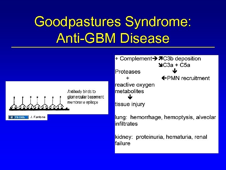 Goodpastures Syndrome: Anti-GBM Disease J. Fantone 