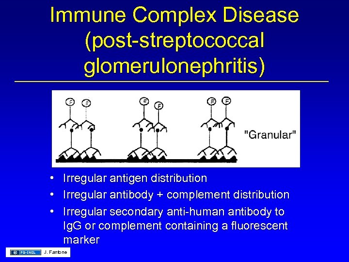 Immune Complex Disease (post-streptococcal glomerulonephritis) • Irregular antigen distribution • Irregular antibody + complement