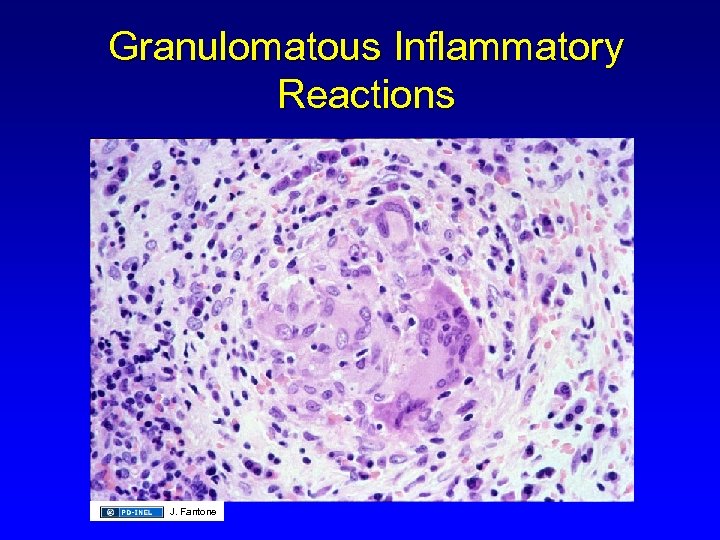 Granulomatous Inflammatory Reactions J. Fantone 
