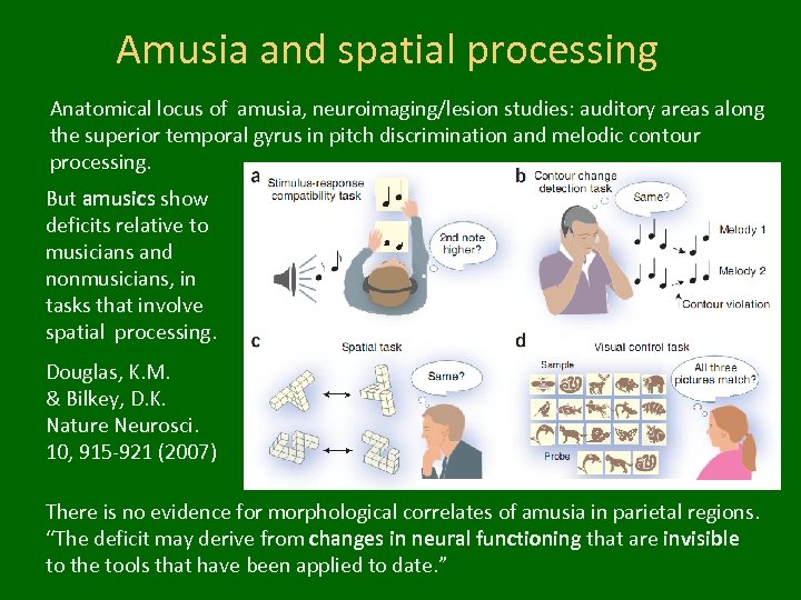 Amusia and spatial processing Anatomical locus of amusia, neuroimaging/lesion studies: auditory areas along the