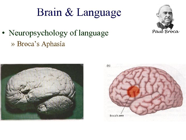 Brain & Language • Neuropsychology of language » Broca’s Aphasia Paul Broca 