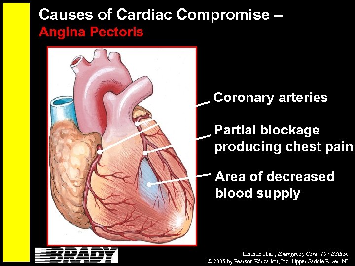 Causes of Cardiac Compromise – Angina Pectoris Coronary arteries Partial blockage producing chest pain