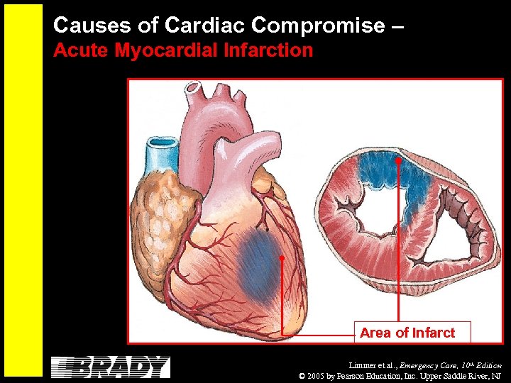 Causes of Cardiac Compromise – Acute Myocardial Infarction Area of Infarct Limmer et al.