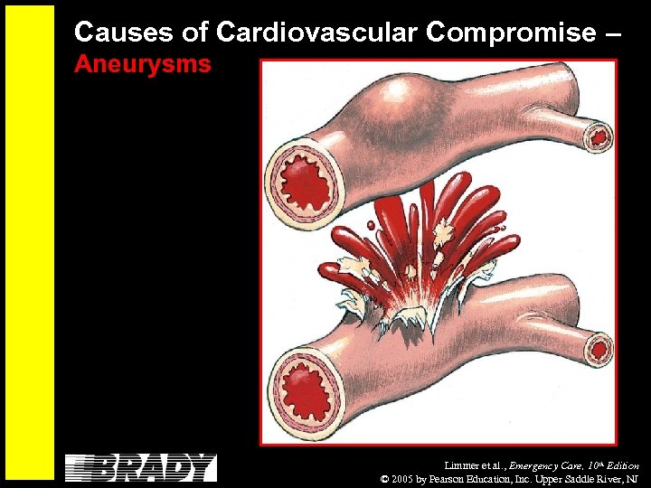 Causes of Cardiovascular Compromise – Aneurysms Limmer et al. , Emergency Care, 10 th