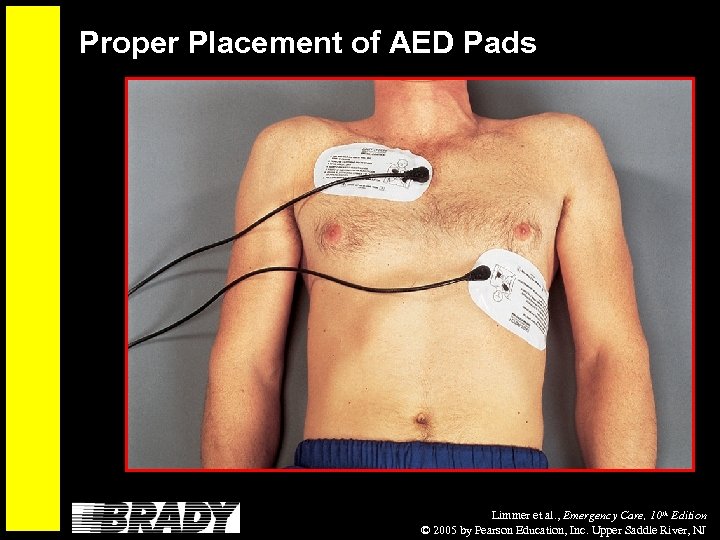 Proper Placement of AED Pads Limmer et al. , Emergency Care, 10 th Edition