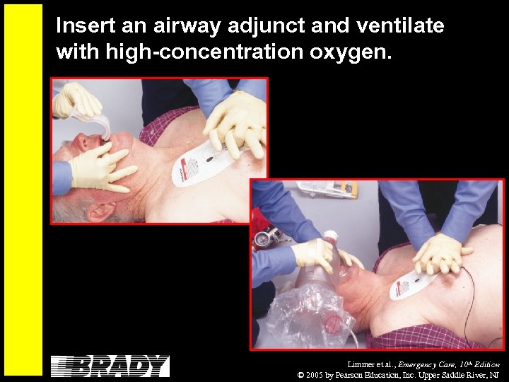 Insert an airway adjunct and ventilate with high-concentration oxygen. Limmer et al. , Emergency
