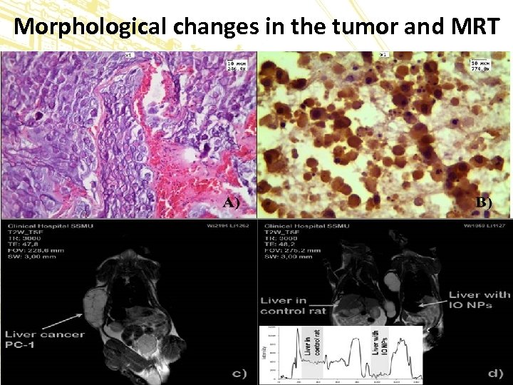 Morphological changes in the tumor and MRT 