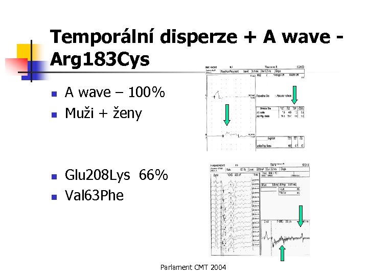 Temporální disperze + A wave Arg 183 Cys n n A wave – 100%