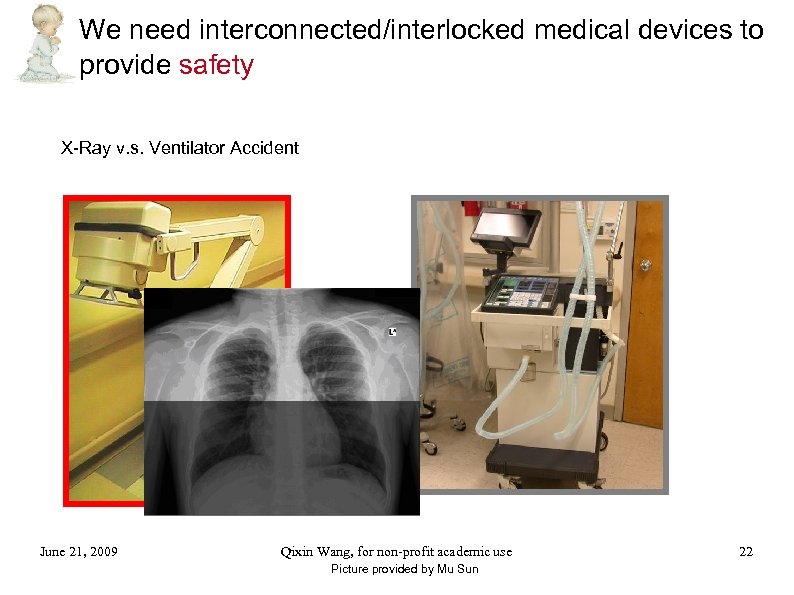 We need interconnected/interlocked medical devices to provide safety X-Ray v. s. Ventilator Accident June