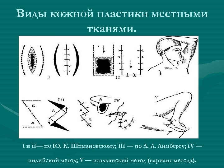 Презентация пластика местными тканями