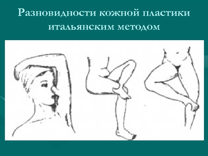 Разновидности кожной пластики итальянским методом 