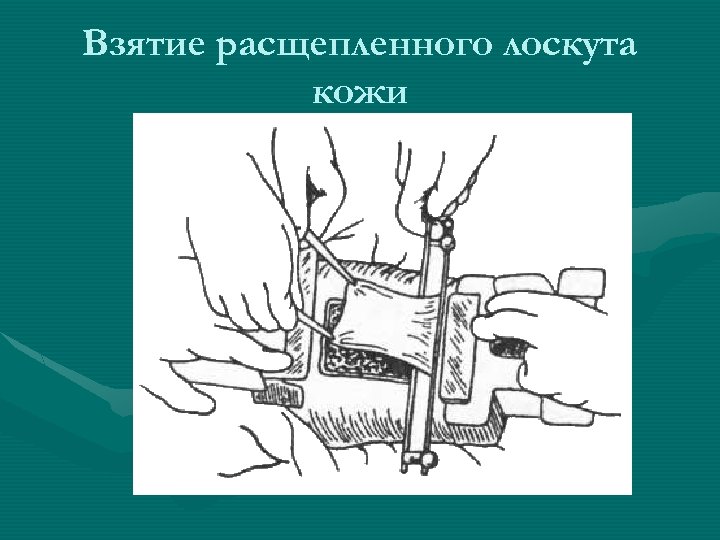 Свободный лоскут. Свободная кожная пластика расщепленным кожным лоскутом. Взятие расщепленного лоскута кожи. Расшепленный кожеый лоскут. Пересадка расщепленного кожного лоскута.