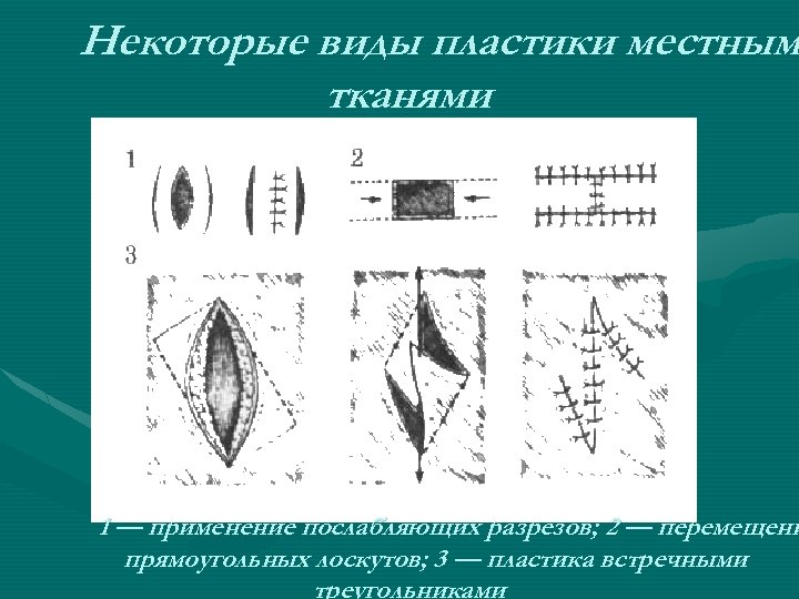 Кожная пластика местными тканями. Пластика фарингостомы местными тканями. Итальянская пластика кожи.