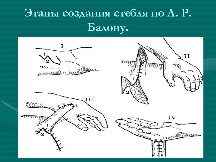 Этапы создания стебля по Л. Р. Балону. 