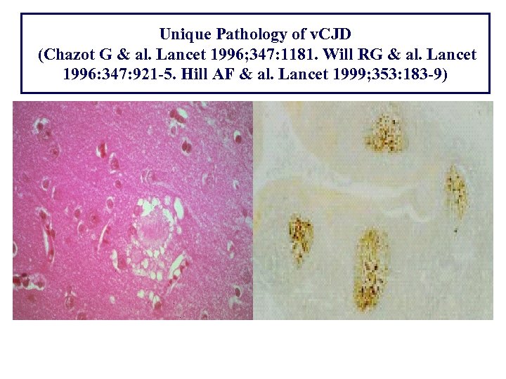 Unique Pathology of v. CJD (Chazot G & al. Lancet 1996; 347: 1181. Will