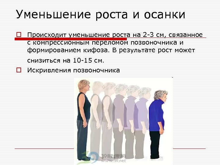 Уменьшение роста и осанки o Происходит уменьшение роста на 2 -3 см, связанное с