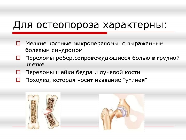 Для остеопороза характерны: o Мелкие костные микропереломы с выраженным болевым синдромом o Переломы ребер,