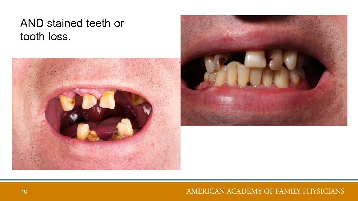 AND stained teeth or tooth loss. 16 