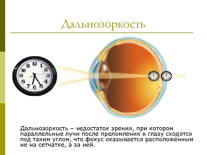 Дальнозоркость – недостаток зрения, при котором параллельные лучи после преломления в глазу сходятся под