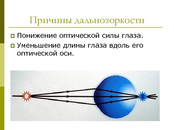 Причины дальнозоркости Понижение оптической силы глаза. p Уменьшение длины глаза вдоль его оптической оси.