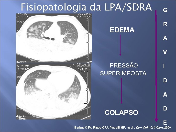 Fisiopatologia da LPA/SDRA EDEMA G R A V PRESSÃO SUPERIMPOSTA I D A COLAPSO