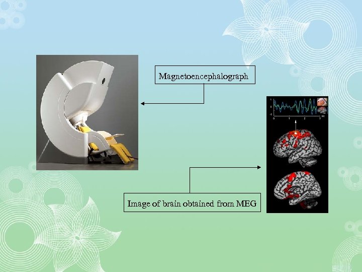 Magnetoencephalograph Image of brain obtained from MEG 