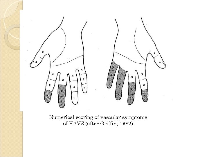 Numerical scoring of vascular symptoms of HAVS (after Griffin, 1982) 