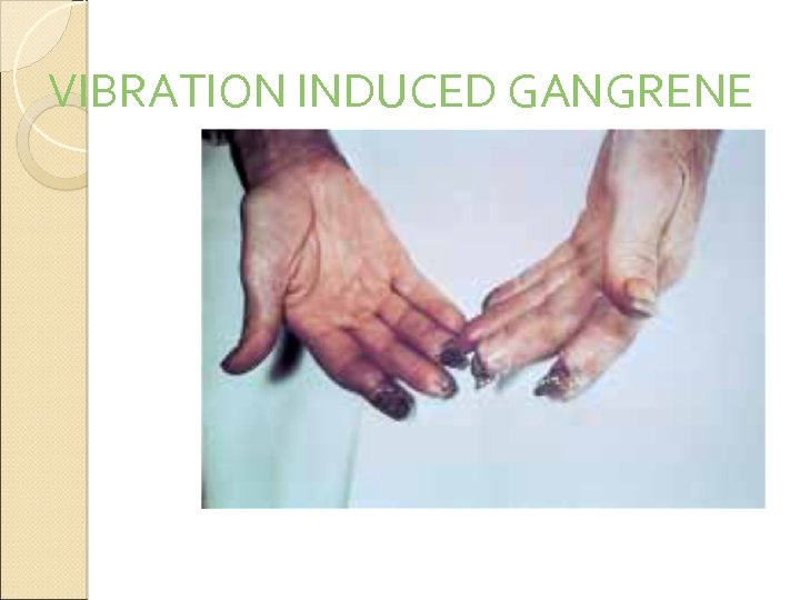 VIBRATION INDUCED GANGRENE 