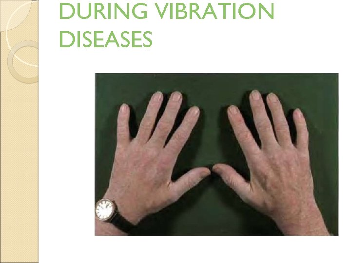 DURING VIBRATION DISEASES 