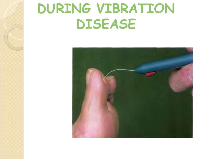 DURING VIBRATION DISEASE 