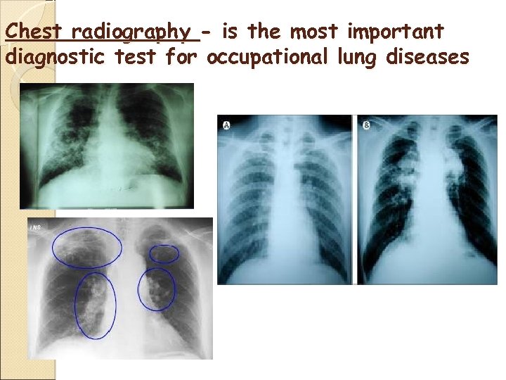 Chest radiography - is the most important diagnostic test for occupational lung diseases 