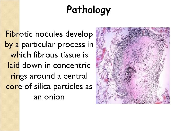 Pathology Fibrotic nodules develop by a particular process in which fibrous tissue is laid