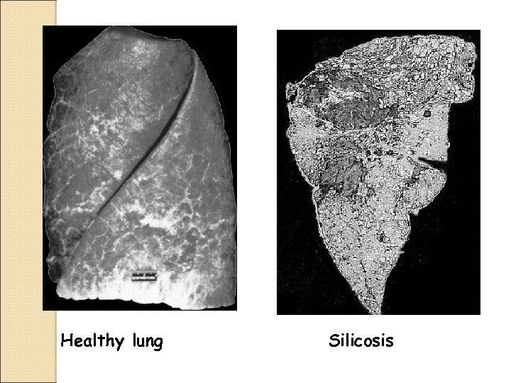 Healthy lung Silicosis 