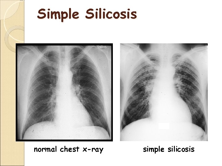 Simple Silicosis normal chest x-ray simple silicosis 