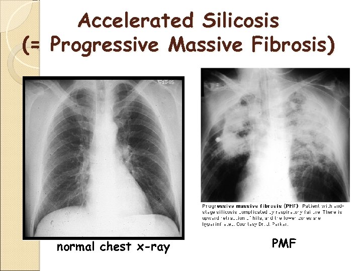 Accelerated Silicosis (= Progressive Massive Fibrosis) normal chest x-ray PMF 